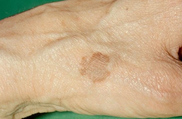 Brown Spots On Skin Causes Symptoms Treatment Remedies Pictures
