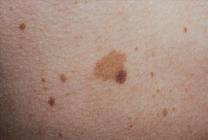 Brown Spots On Skin