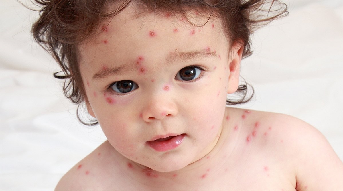 chicken pox research article