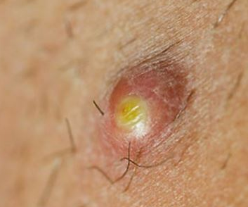 Cysts On Inner Thigh