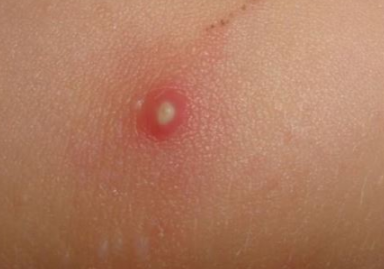 Cysts On Inner Thigh