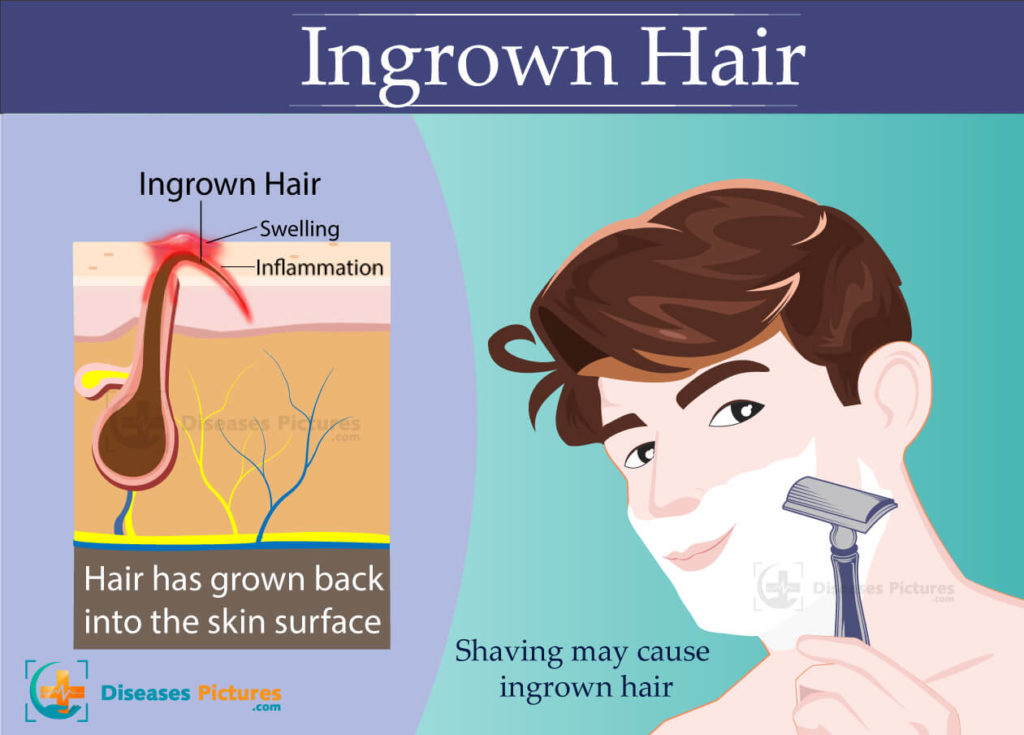 Ingrown Hair Causes, Treatment, Removal, Infected, Cyst