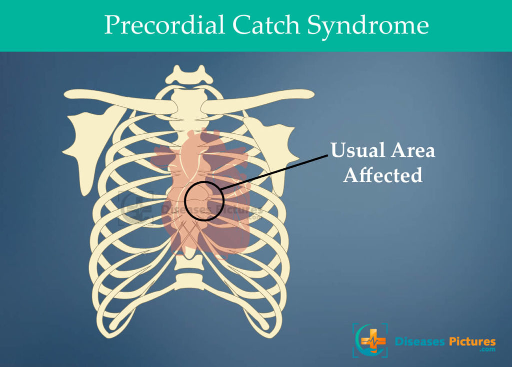 Precordial Catch Syndrome
