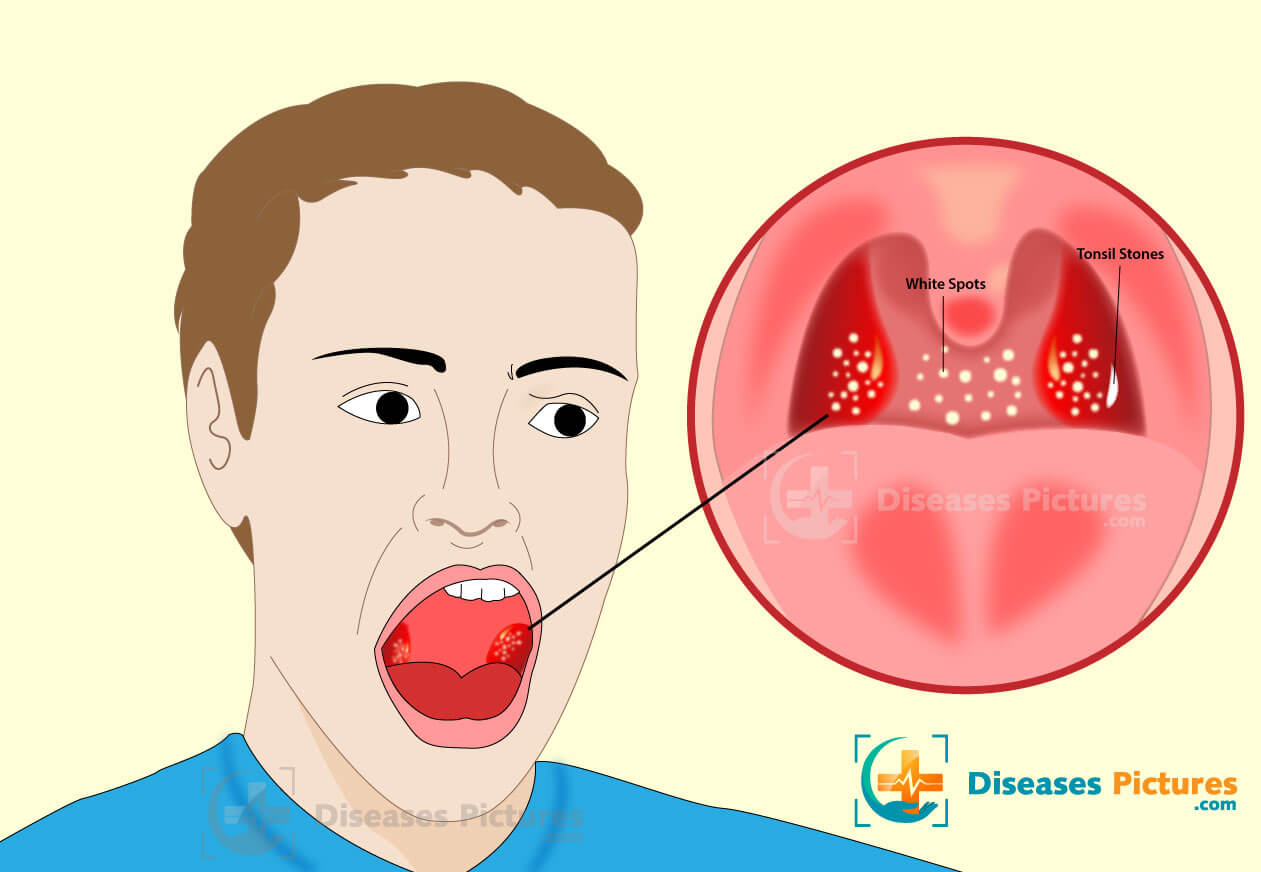 White Spots On Tonsils Should You Panic Swollen Tonsils Mouth | Images ...