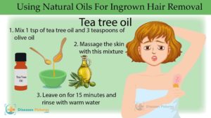 ingrown hair Home Remedies