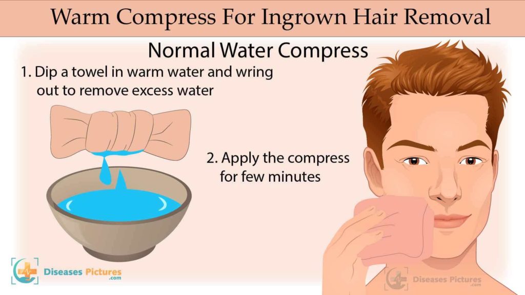 ingrown hair Home Remedies