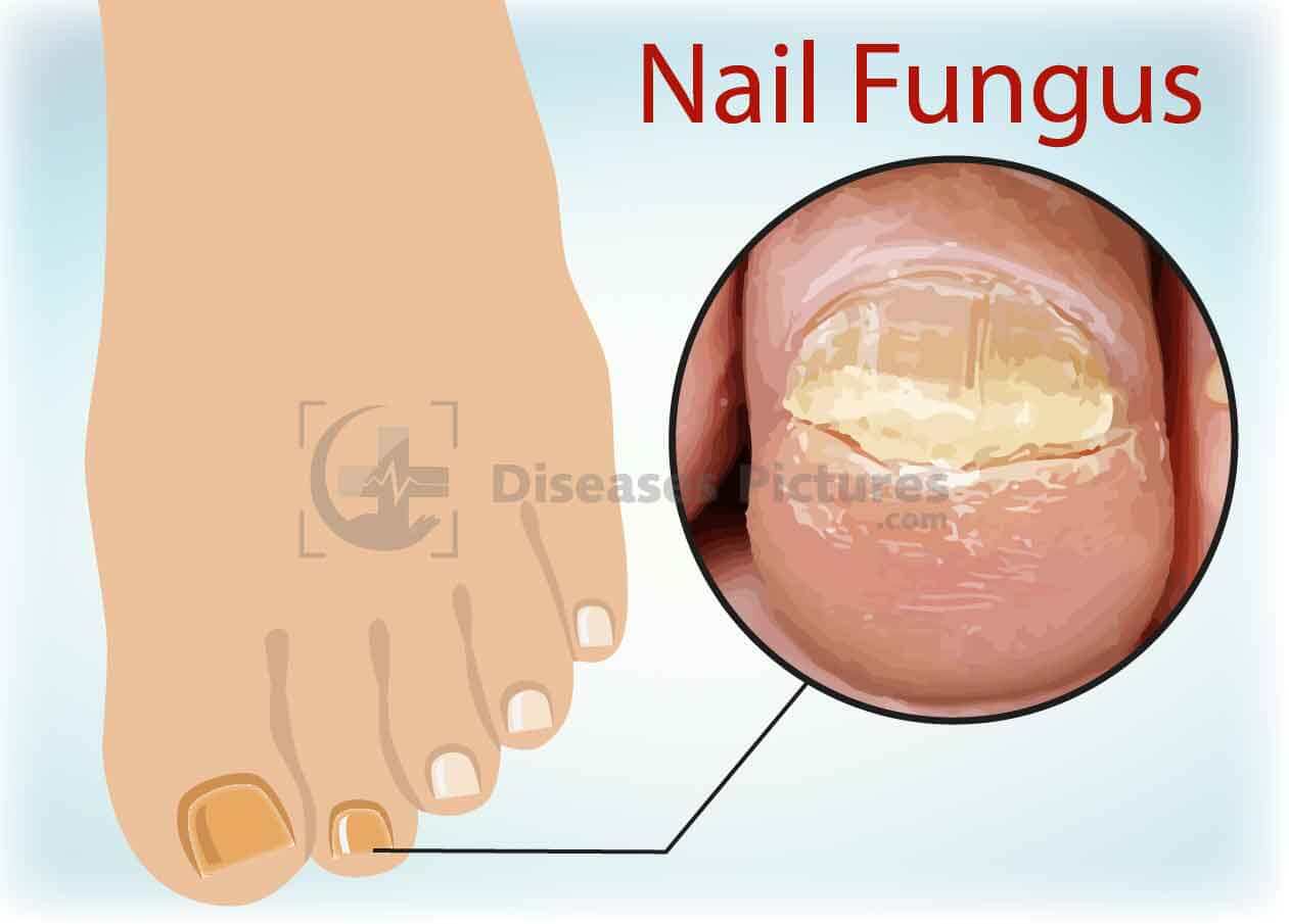 toenail fungus.