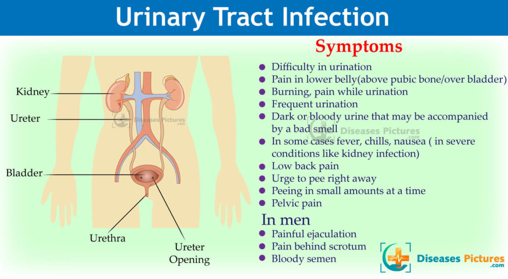Does prostatitis cause burning after urination