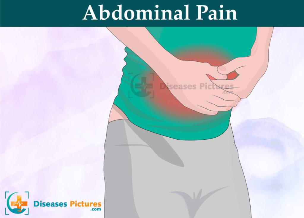Abdominal Pain