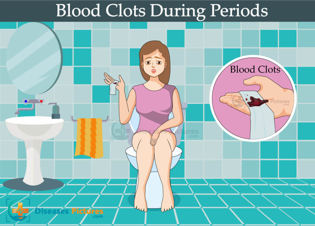 Blood Clots During Period