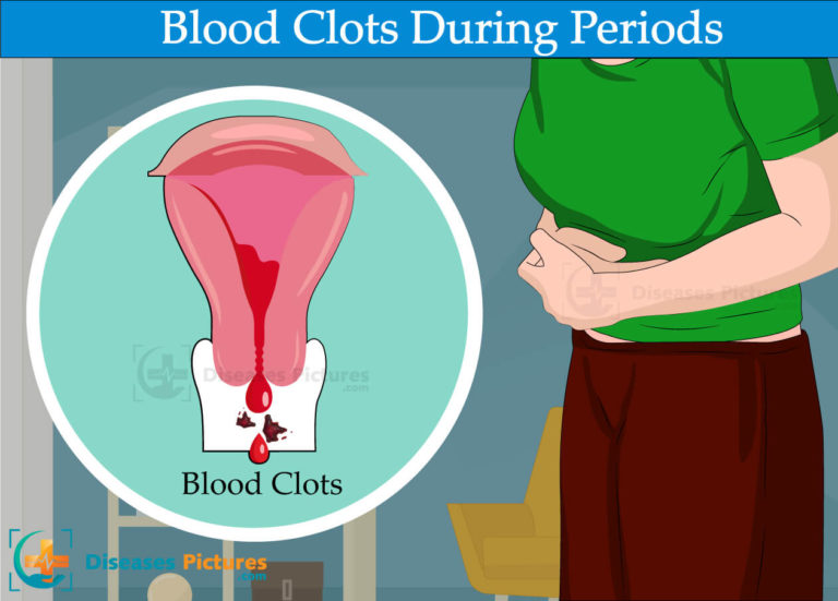 Blood Clots During Period 768x551 