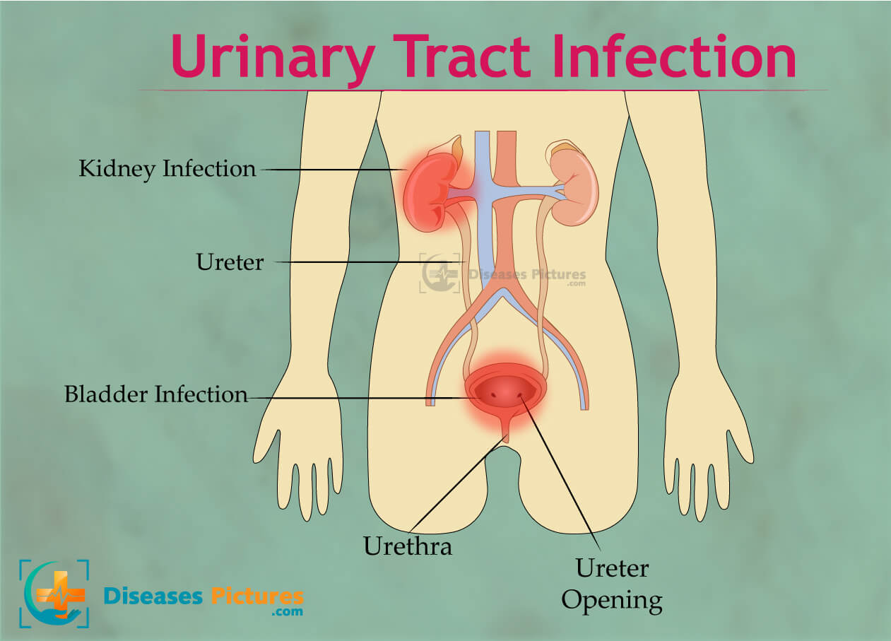 Que tomar para infeccion urinaria