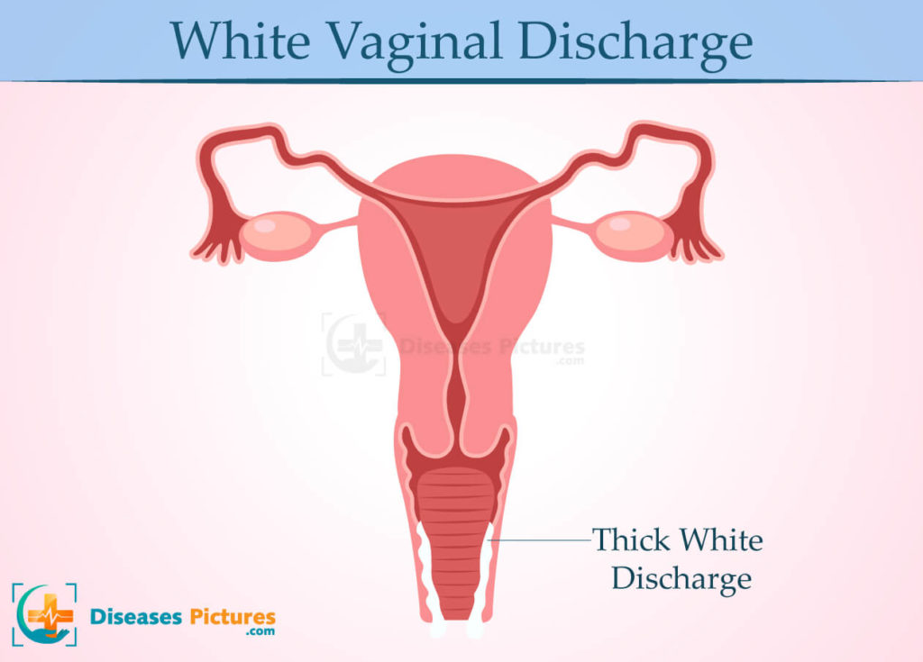 White Vaginal Discharge
