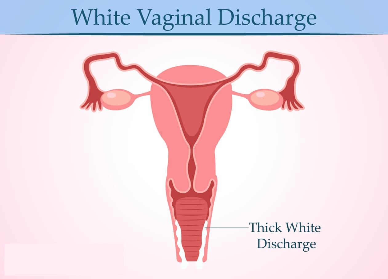 White Vaginal Discharge
