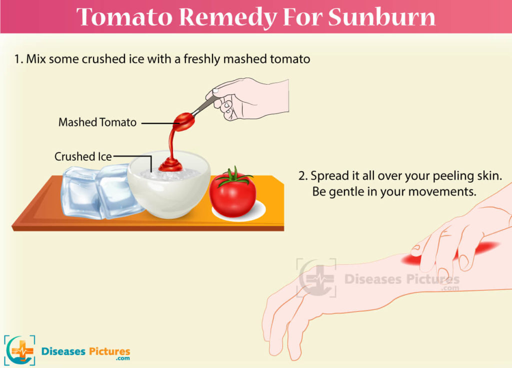 sunburn remedies