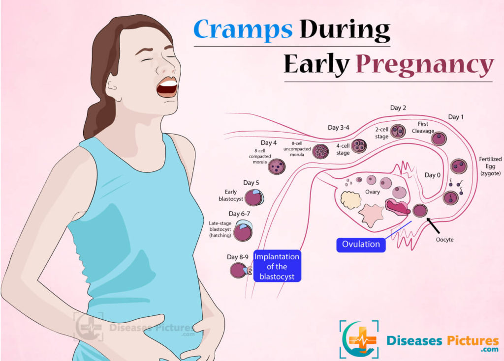 Cramps During Early Pregnancy