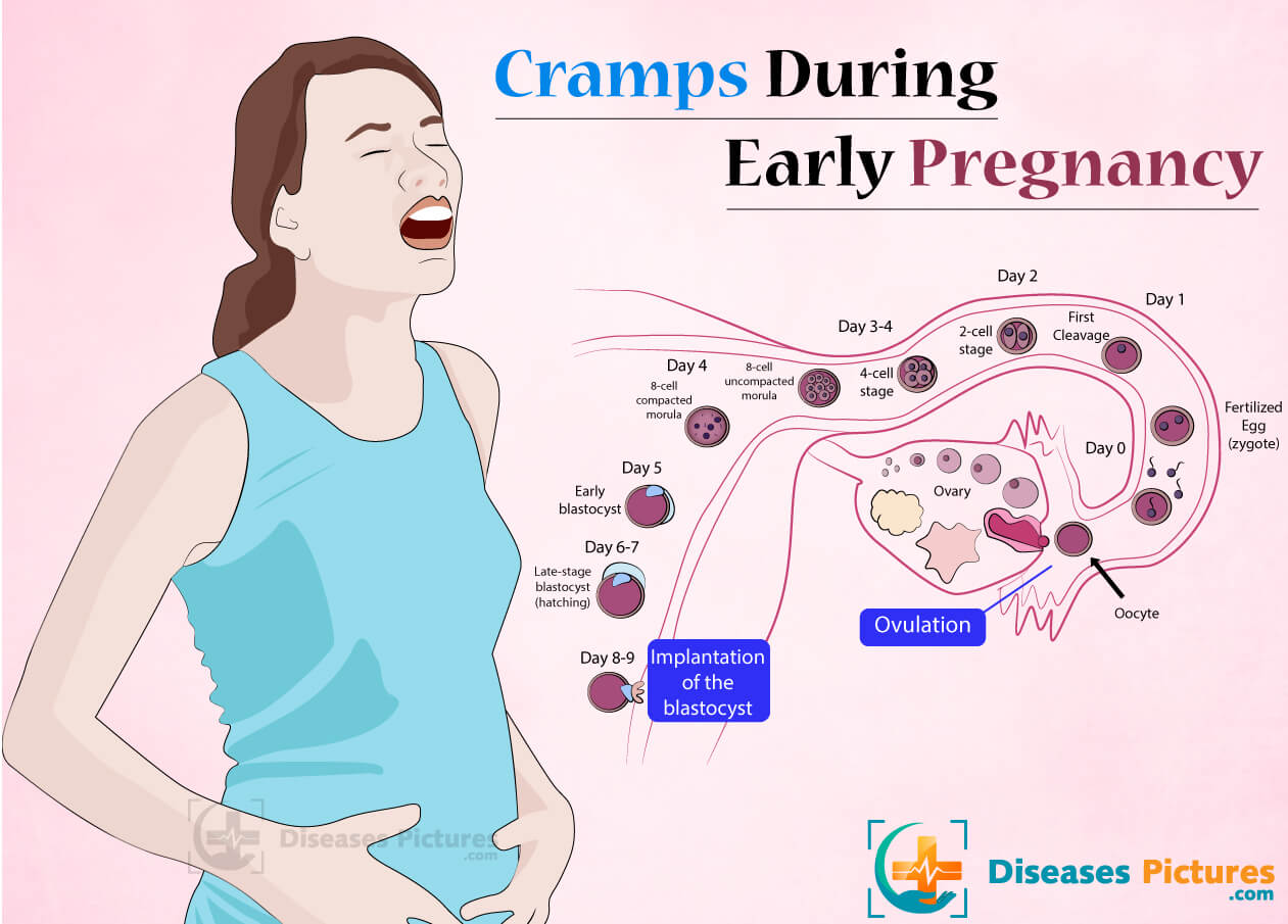 Cramps During Pregnancy - Cramping Early Pregnancy | HealthMD