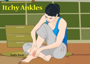Itchy Ankles
