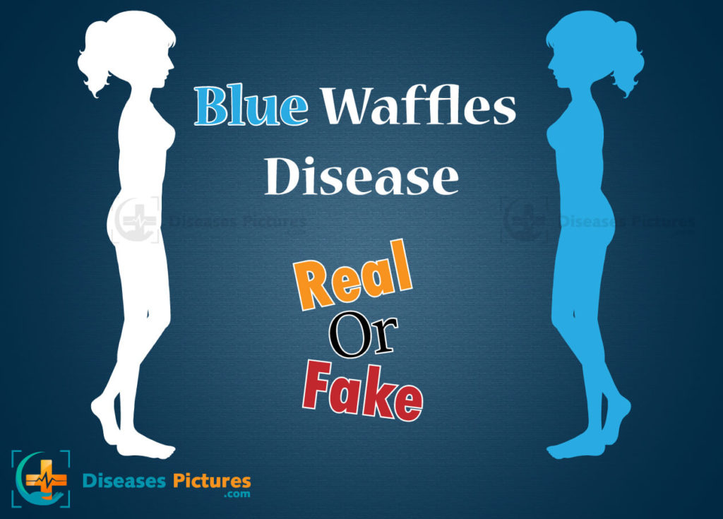 blue waffle disease.